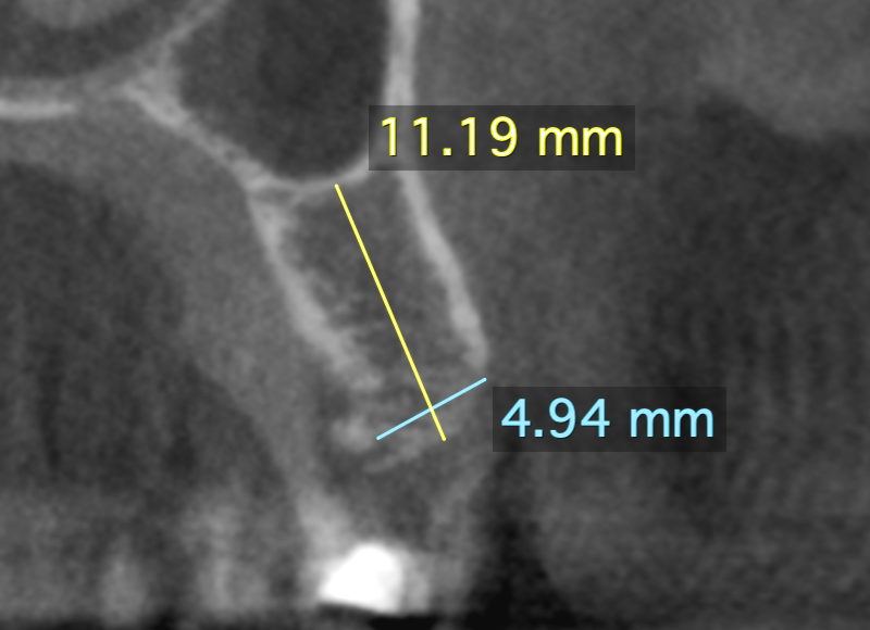 implant